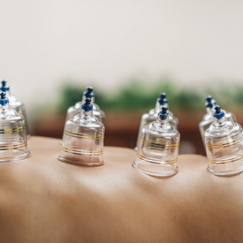 Hijama Cupping Treatment on Women's Back